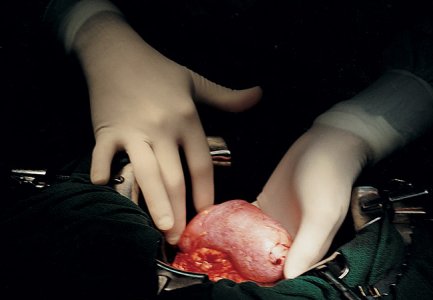 mazh se vazstanovyava sled transplantacziya na babrek ot prase 2 https://netnews.bg/wp-content/uploads/2024/03/mazh-se-vazstanovyava-sled-transplantacziya-na-babrek-ot-prase-2.jpg
